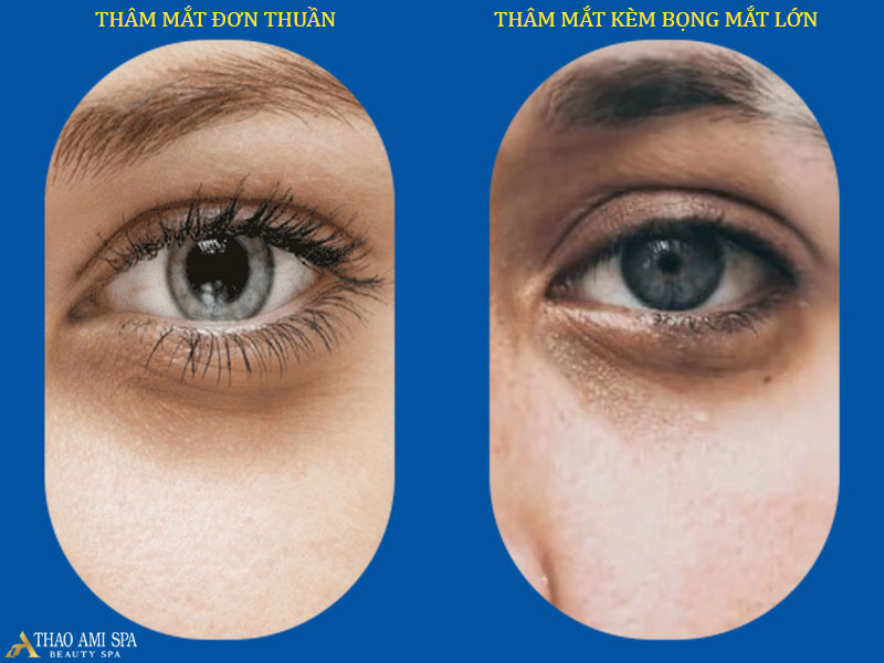 Thâm mắt được chia thành 2 loại