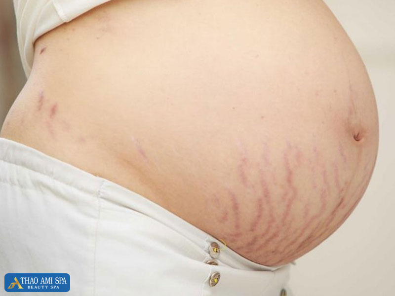 Phụ nữ thường bị rạn da lúc mang thai