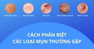 Cách phân biệt cá loại mụn thường gặp