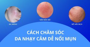 Cách chăm sóc da nhạy cảm dễ nổI mụn