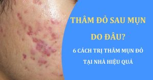 thâm đỏ sau mụn