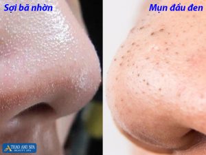 Sợi bã nhờn và mụn đầu đen có những khác biệt nhất định