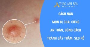 Cách nặn mụn bị chai cứng