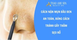 Cách nặn mụn đầu đen đúng cách