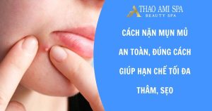 Cách nặn mụn mủ không để lại sẹo