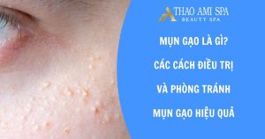 Cách điều trị mụn gạo