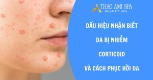 Dấu hiệu da bị nhiễm corticoid