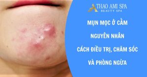 Mụn mọc ở cằm