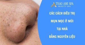 Cách trị mụn mọc ở mũi tại nhà bằng nguyên liệu tự nhiên