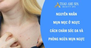 Nguyên nhân mụn mọc ở ngực và cách điều trị hiệu quả