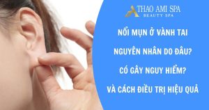 Mụn mọc ở vành tai do đâu? Cách xử lý hiệu quả