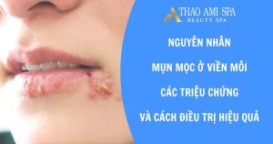 Cách điều trị mụn mọc ở viền môi