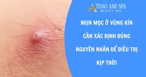 Mụn mọc ở vùng kín