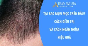 Mụn mọc trên đầu