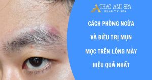 Mụn mọc trên lông mày