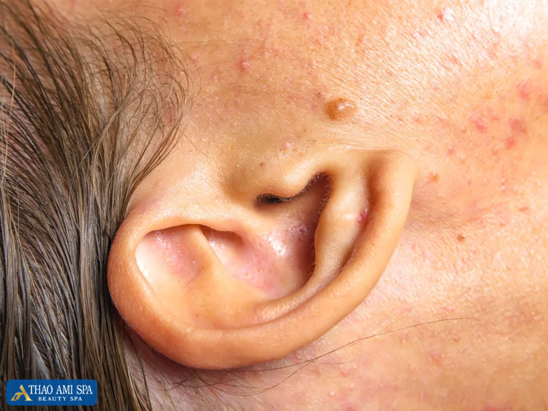 Nguyên nhân gây ra mụn mọc ở vành tai