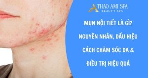 Mụn nội tiết là gì và cách điều trị hiệu quả