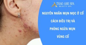 Mụn mọc ở cổ