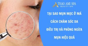 Tại sao mụn mọc ở má