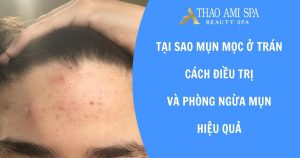 Tại sao mụn mọc ở trán?