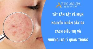 Tất tần tật về mụn: Nguyên nhân phổ biến, cách điều trị và những lưu ý quan trọng