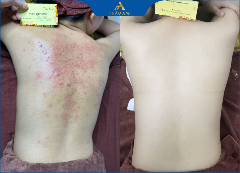 Kết quả trị mụn lưng, viêm nang lông tại Thảo Ami Spa Hà Nội