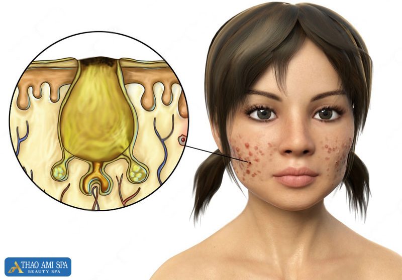 Vi khuẩn P.acnes là nguyên nhân chính gây ra các loại mụn thường gặp.
