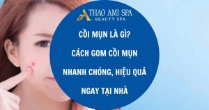 Cồi mụn là gì? Cách gom cồi mụn hiệu quả tại nhà