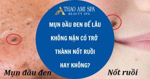 Mụn để lâu không nặn có trở thành nốt ruồi không?