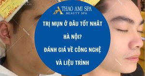 Trị mụn ở đâu tốt nhất Hà Nội: Đánh giá công nghệ, liệu trình