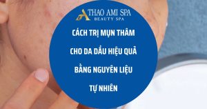 Cách trị mụn thâm cho da dầu hiệu quả ngay tại nhà