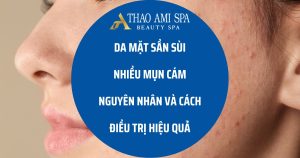 Da mặt sần sùi nhiều mụn cám - nguyên nhân và cách điều trị hiệu quả