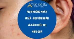 Mụn không nhân ở má - Nguyên nhân và cách điều trị hiệu quả