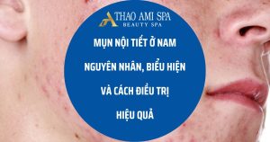 Cách điều trị mụn nội tiết ở nam giới