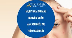 Mụn thâm tụ máu: Nguyên nhân và cách điều trị hiệu quả