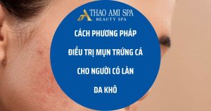 Cách điều trị mụn cho người có da khô