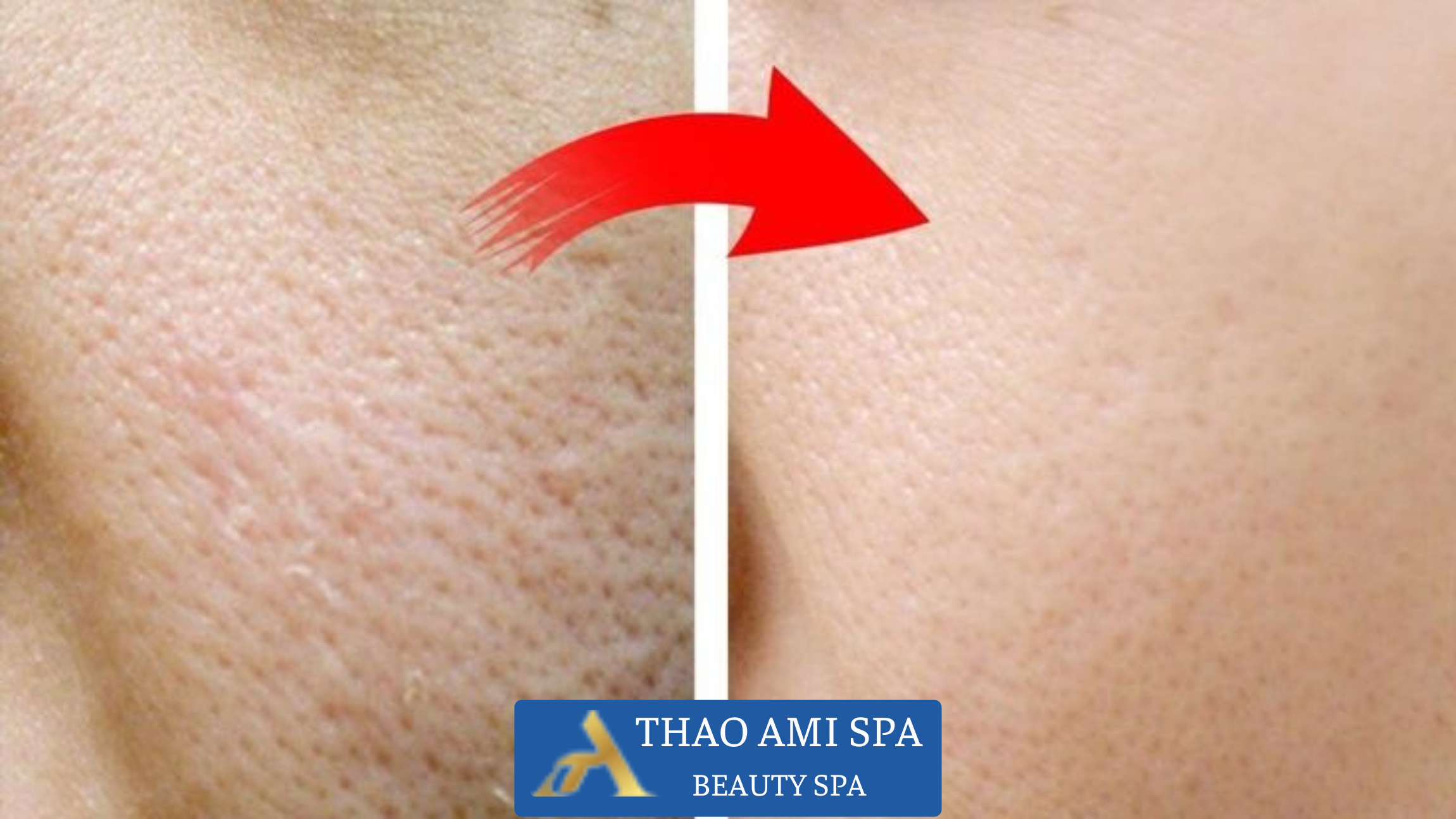 Se khít lỗ chân lông