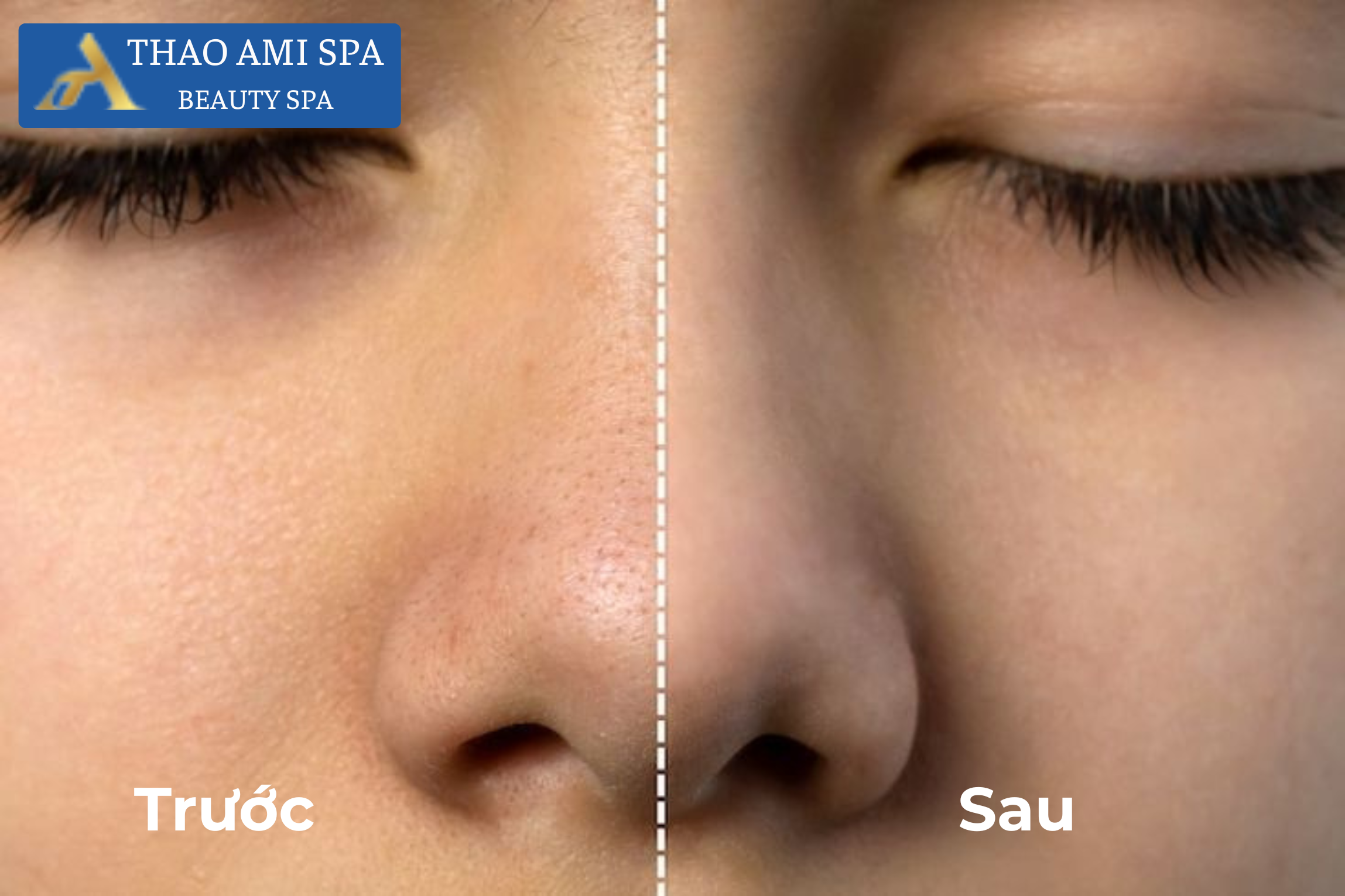 Làm sạch mụn đầu đen