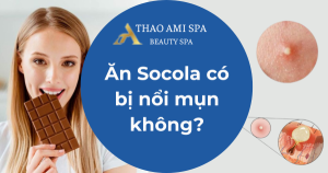 Ăn Socola có bị nổi mụn không