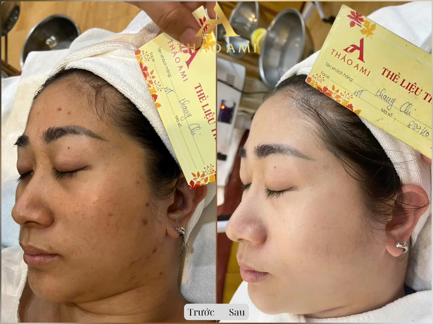 chị Chi sau khi điều trị tại Thảo Ami SPa