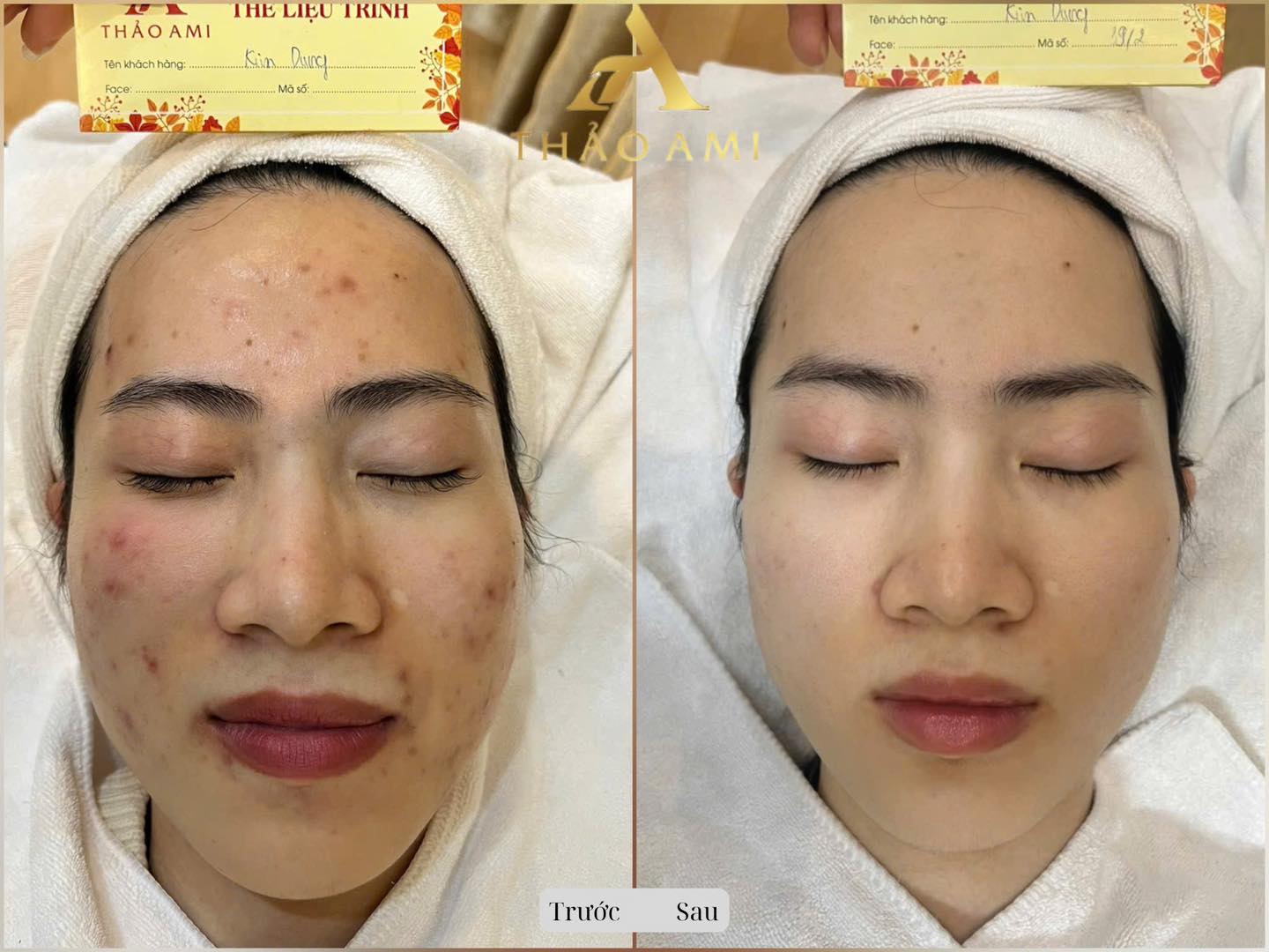 Kết quả trước và sau khi điều trị mụn tại Thảo Ami Spa