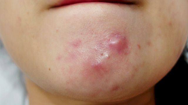mụn cục cứng
