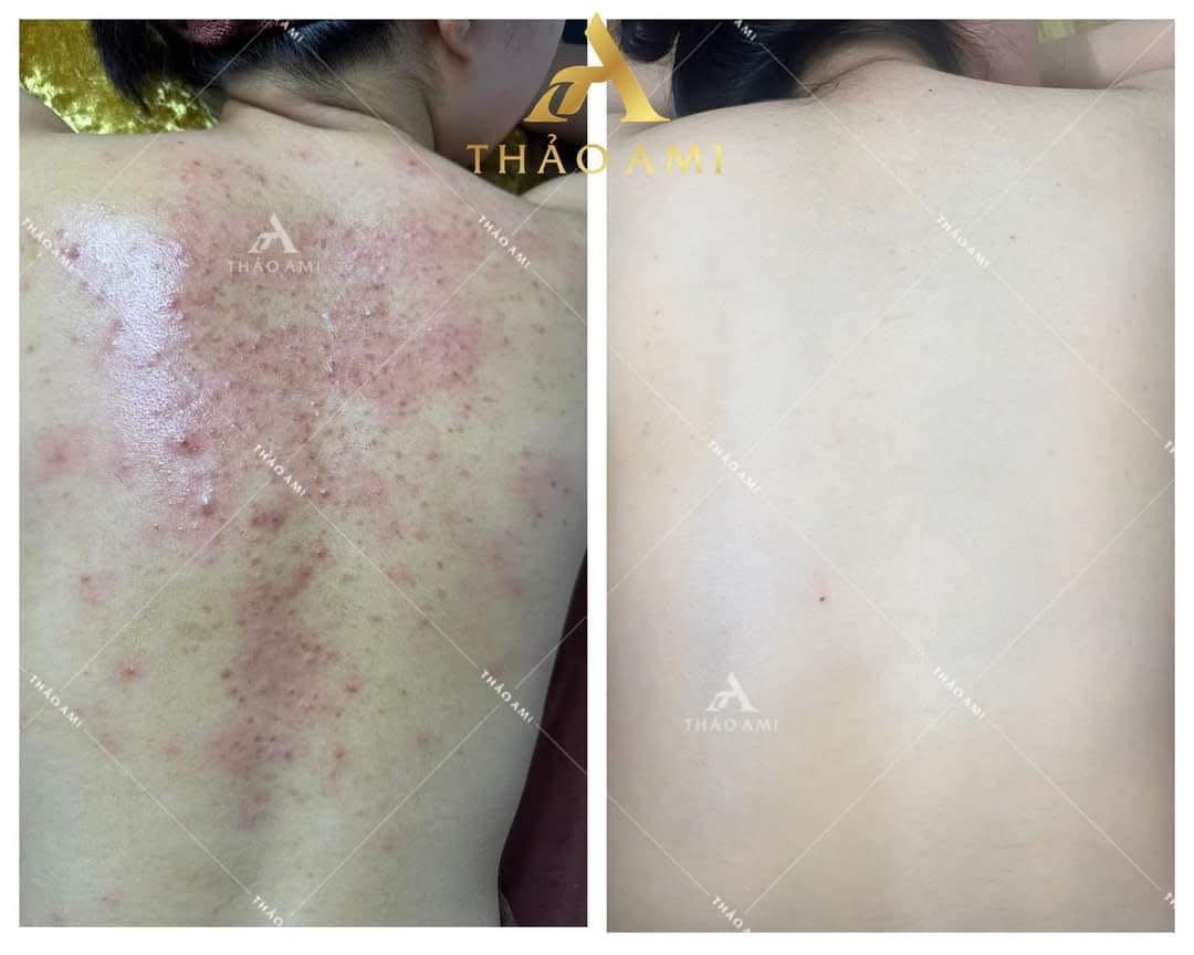 Mụn lưng sau khi điều trị