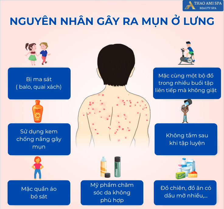Nguyên nhân gây ra mụn ở lưng