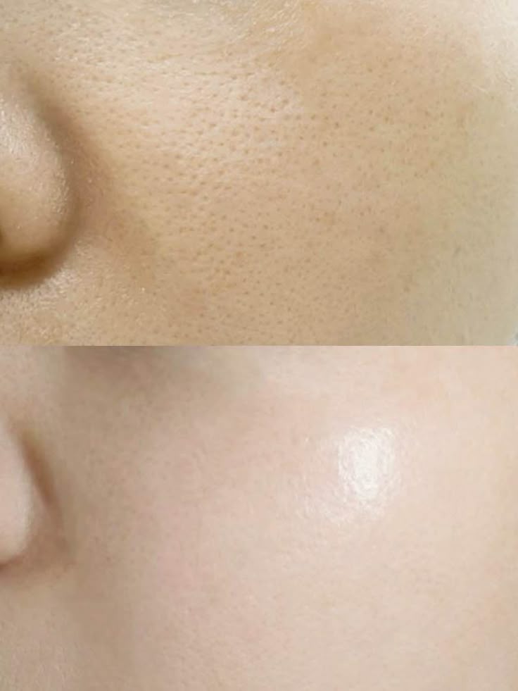 Trước và sau khi điều trị mụn cám