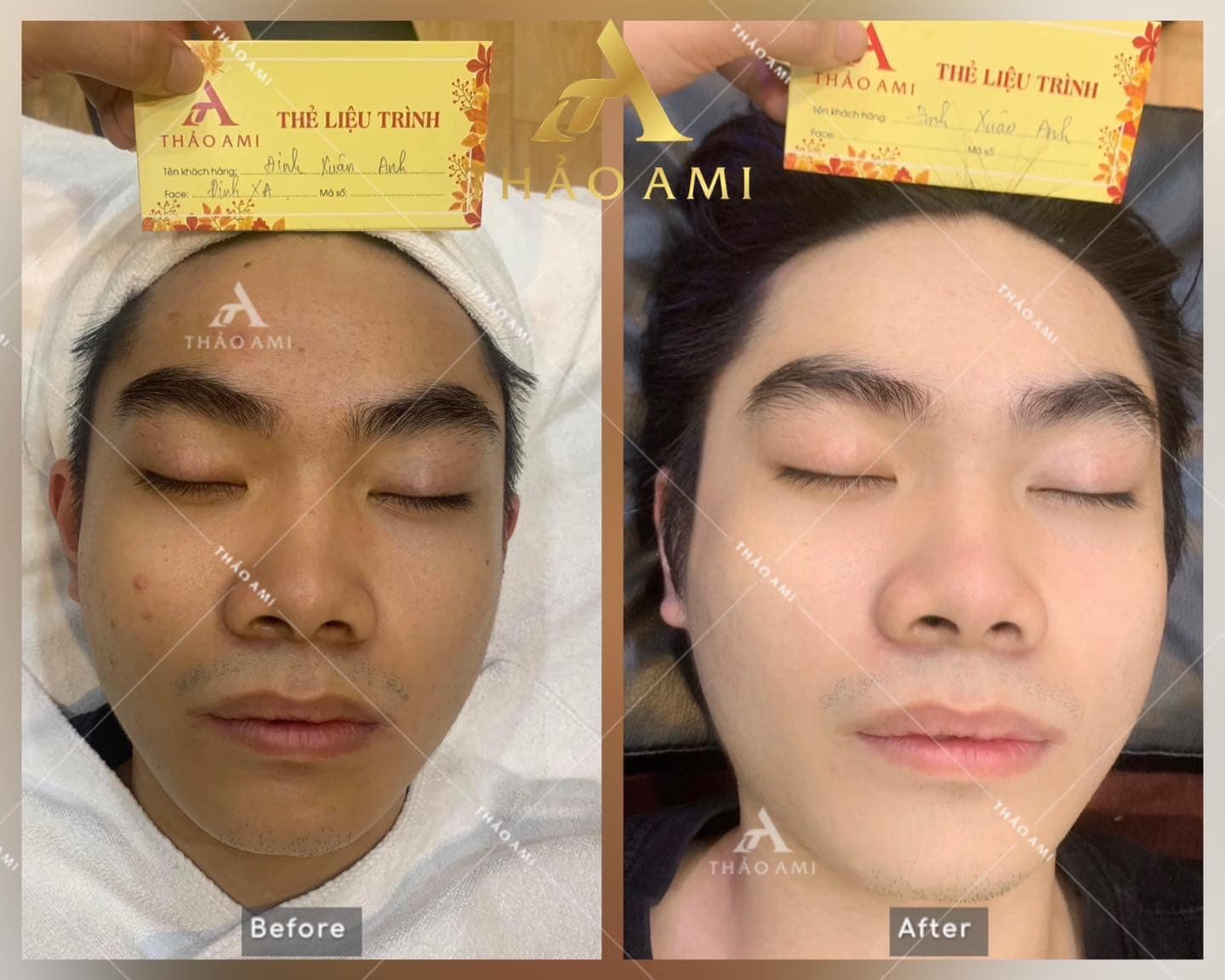 Kết quả điều trị mụn sau liệu trình tại Thảo Ami Spa