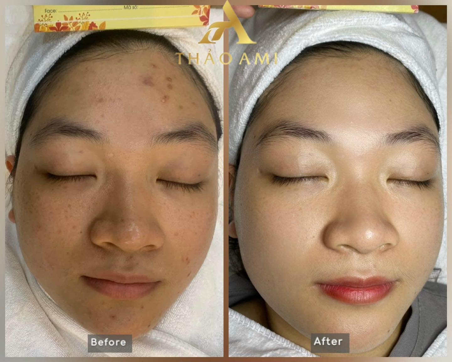 Điều trị mụn tại Thảo Ami Spa