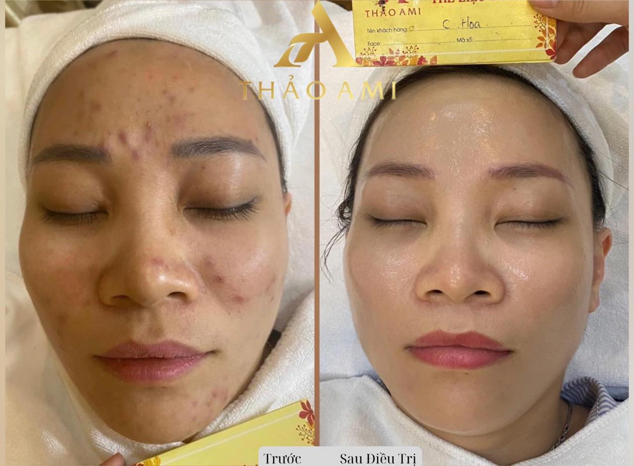 Điều trị mụn viêm tại Thảo Ami SPa