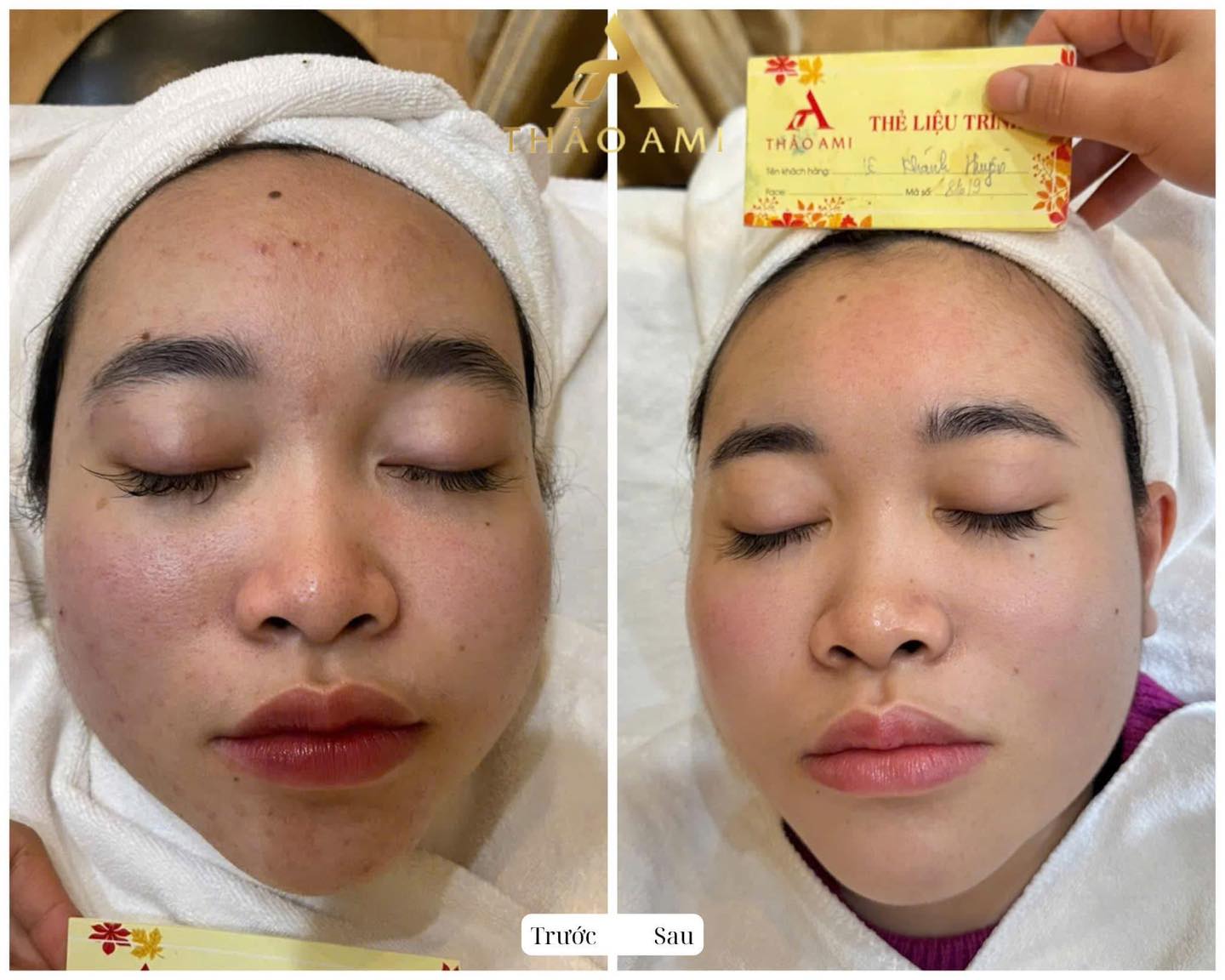 Kết quả sau khi điều trị mụn viêm tại Thảo Ami Spa