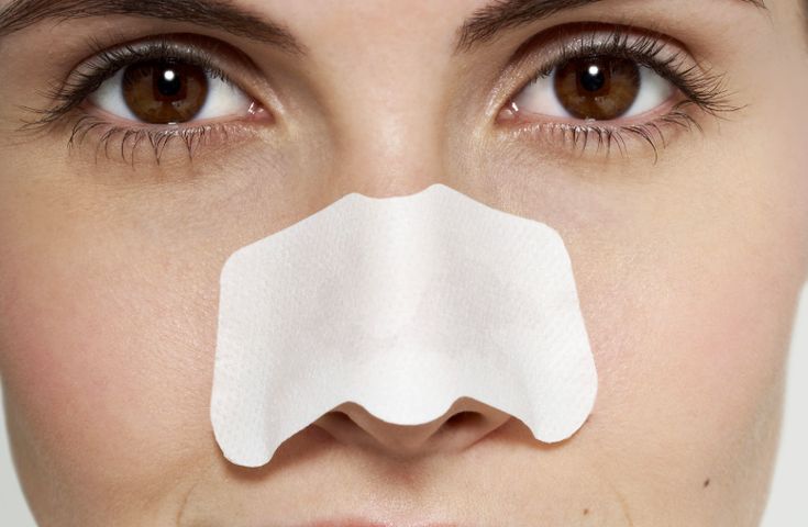 lột mụn bằng miếng dán